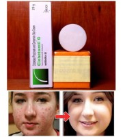 Clobetamil G set  (malasiyan)